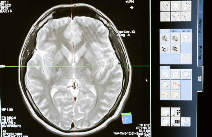 blood group subject to stroke