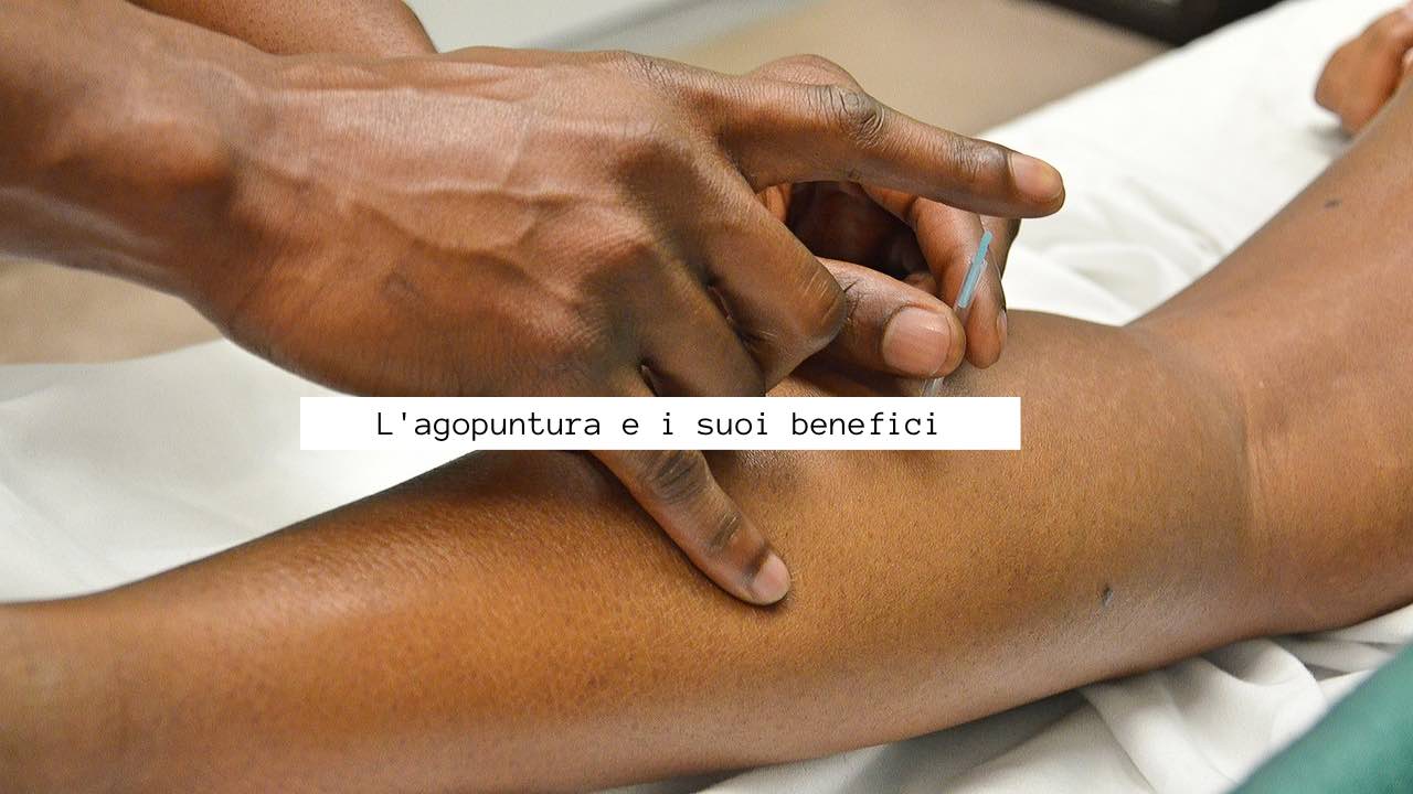 agopuntura benefici