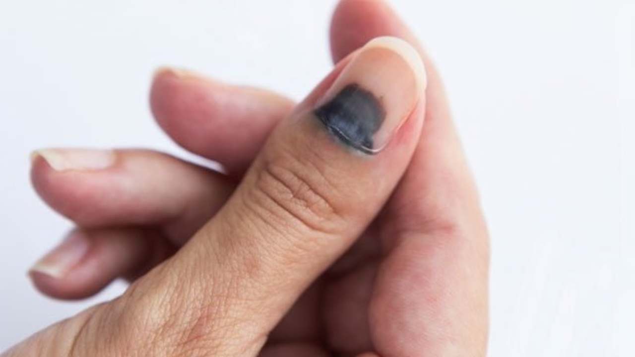 Perché le unghie diventano nere cause motivi rimedi