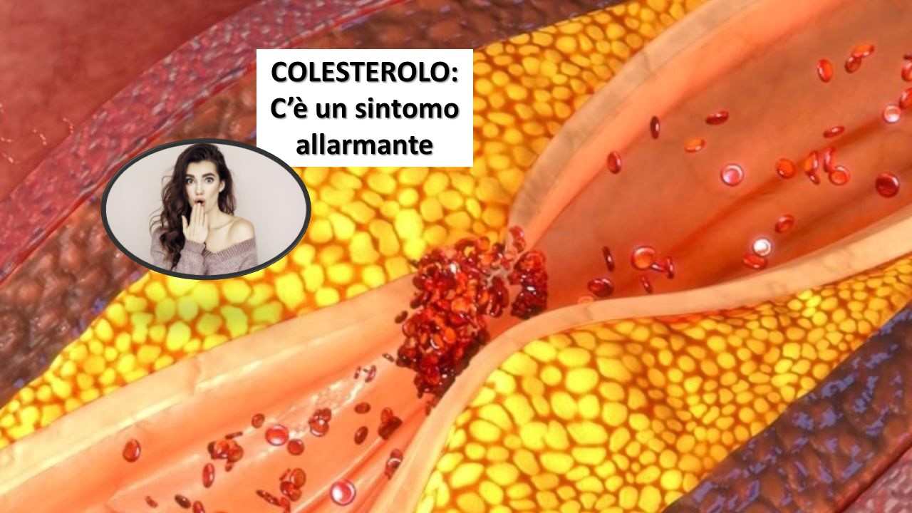 Sintomo allarmante Colesterolo alto