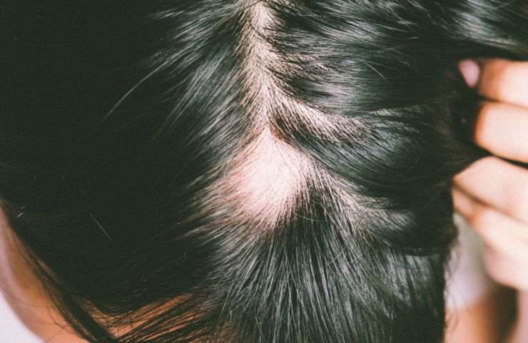 alopecia nelle donne