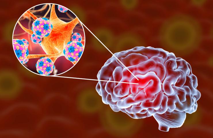 sintomi meningite