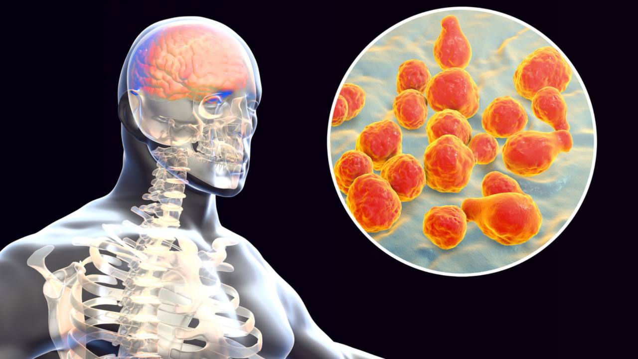 meningite fulminante