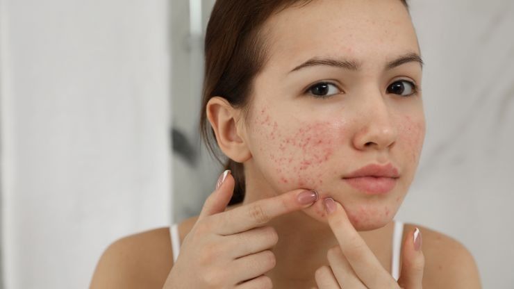 rimedi contro l'acne
