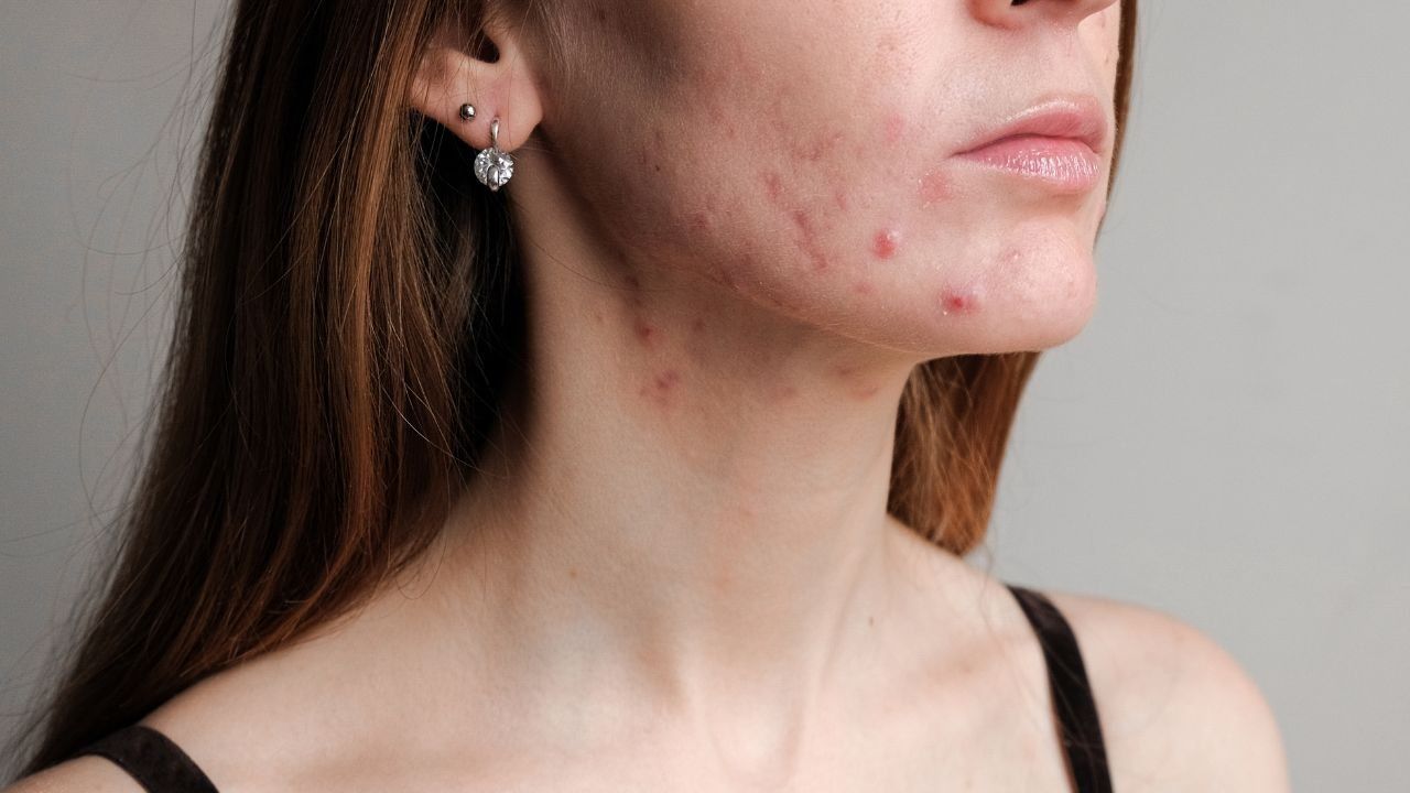 contro acne