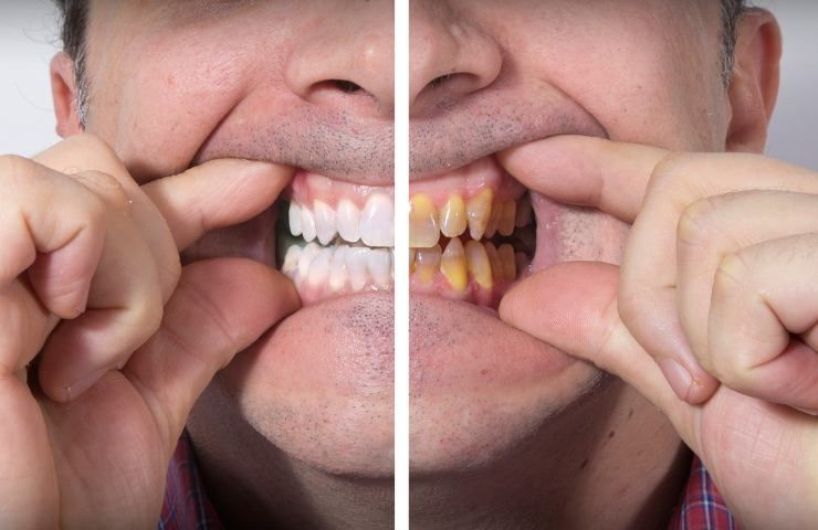 5 abitudini cattiva igiene orale