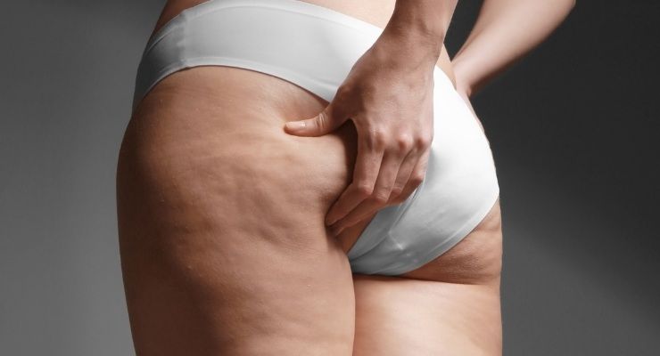 Cellulite come eliminarla