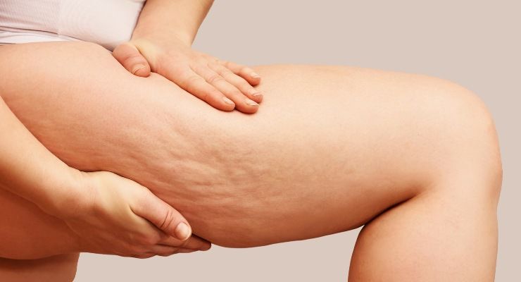 Come eliminare cellulite