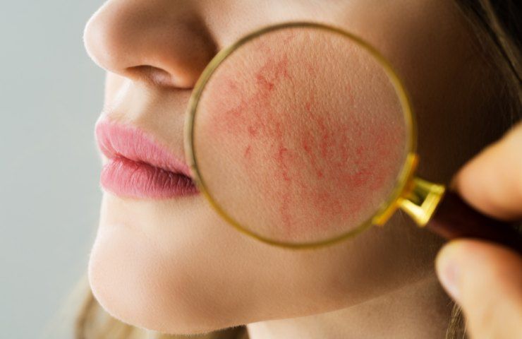 pelle si irrita arrossata rimedi naturali