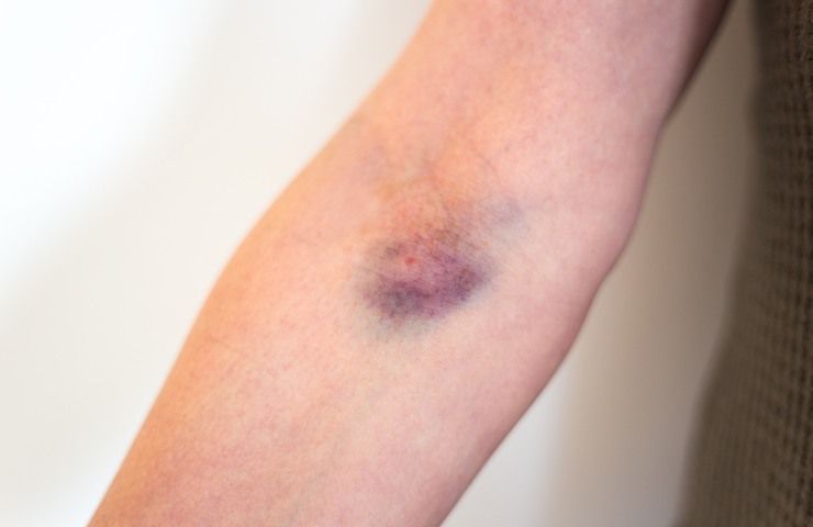 Un vistoso livido viola su un braccio
