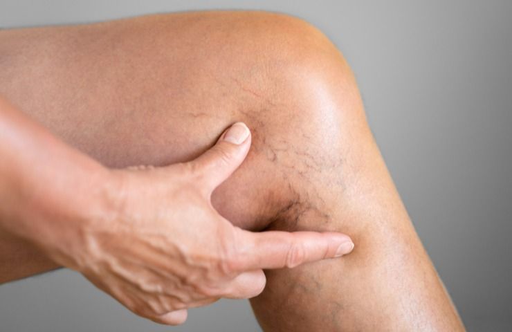 Vene varicose curarle consigli pratici