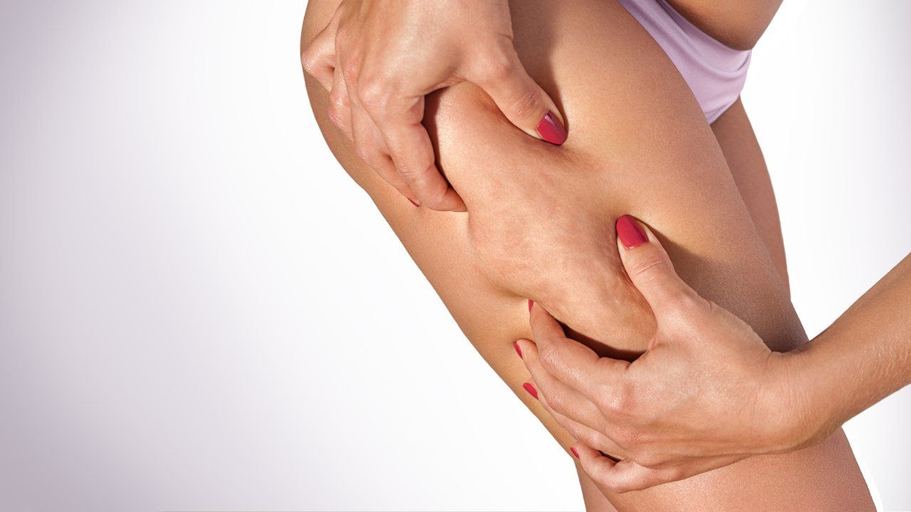 Cellulite e cuscinetti adiposi