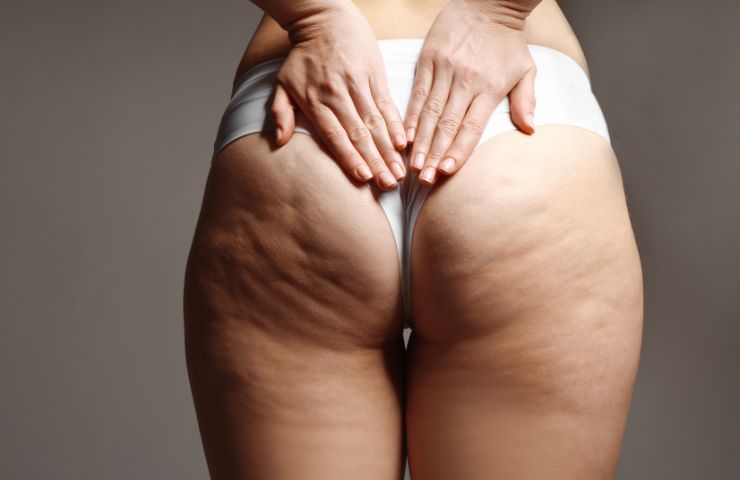 Cellulite come abbandonarla