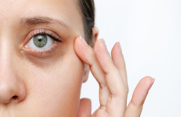 Occhiaie fette cetrioli trucco