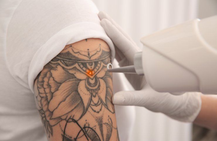 tatuaggio laser come funziona