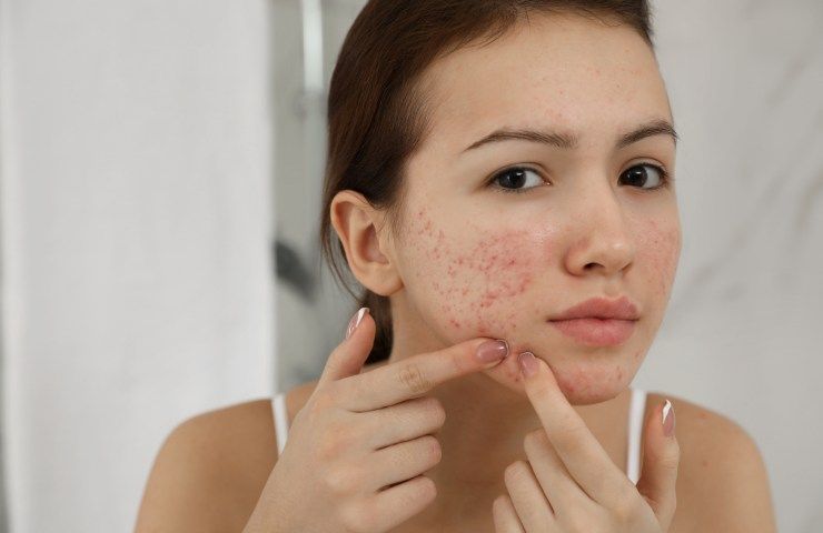 Donna con vistosa acne sul volto