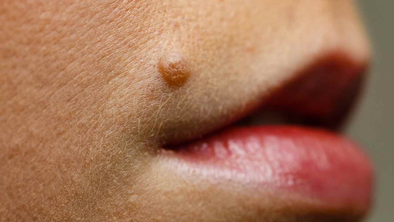 nei pelosi come eliminarli cura dermatologo