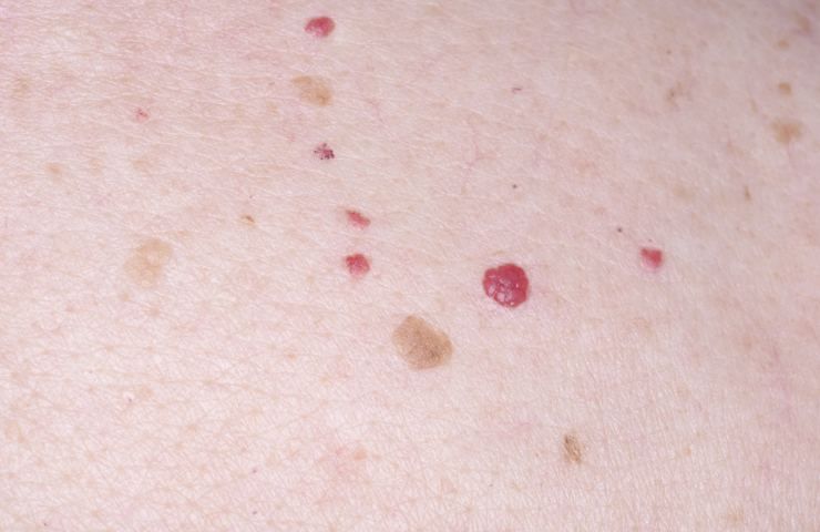 Cosa può provocare un angioma?