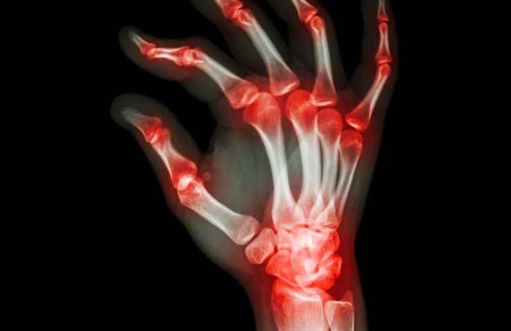 Quali sport ed esercizi fare con l'artrite reumatoide