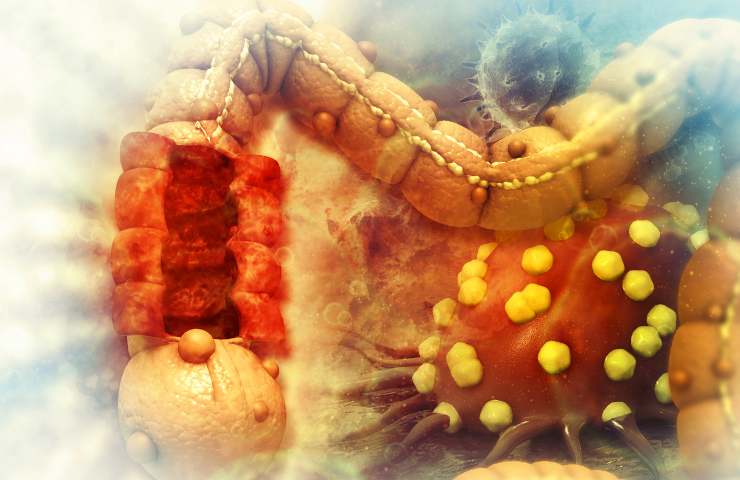 Cancro al colon sintomi
