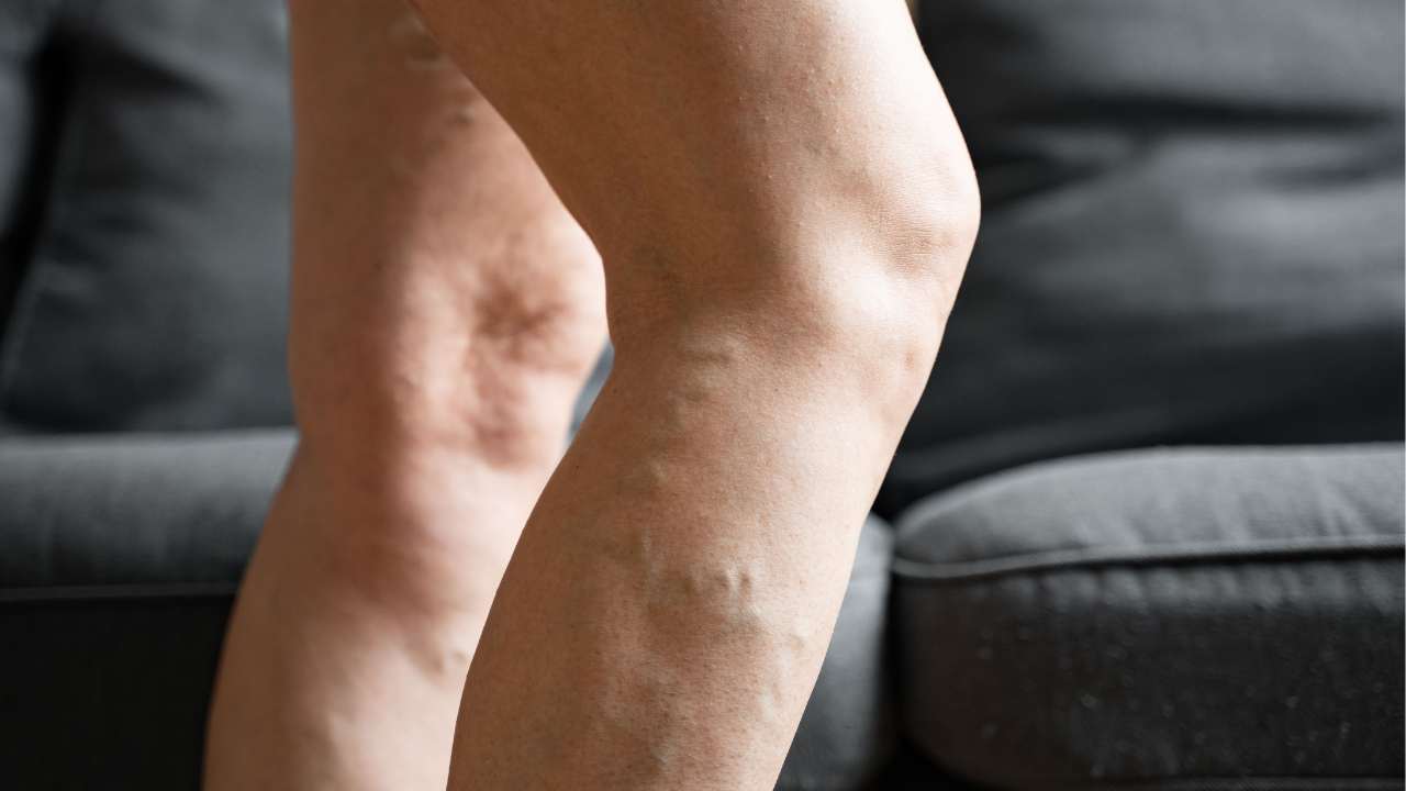 Cosa fare per gambe e piedi gonfi