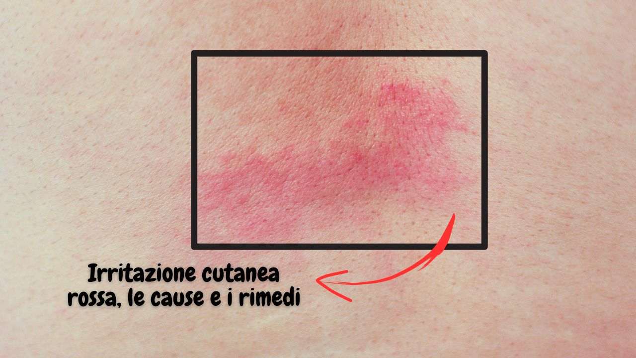 irritazione cutanea rossa