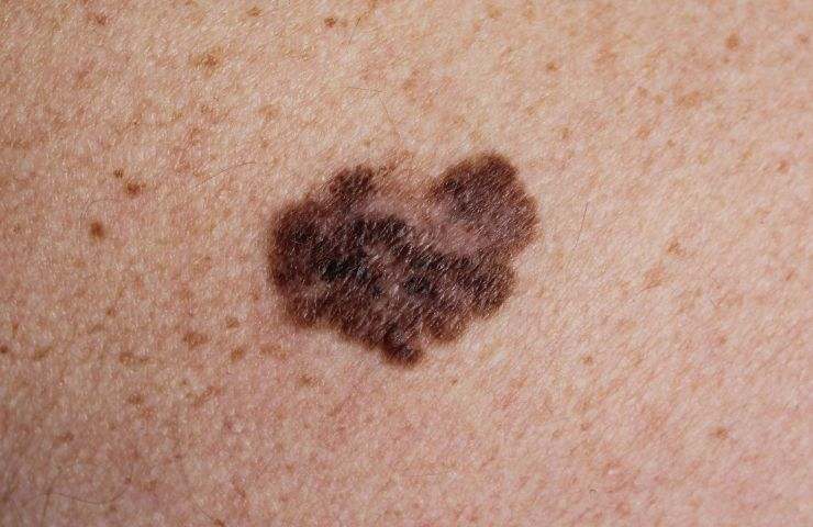 prevenzione melanoma pelle