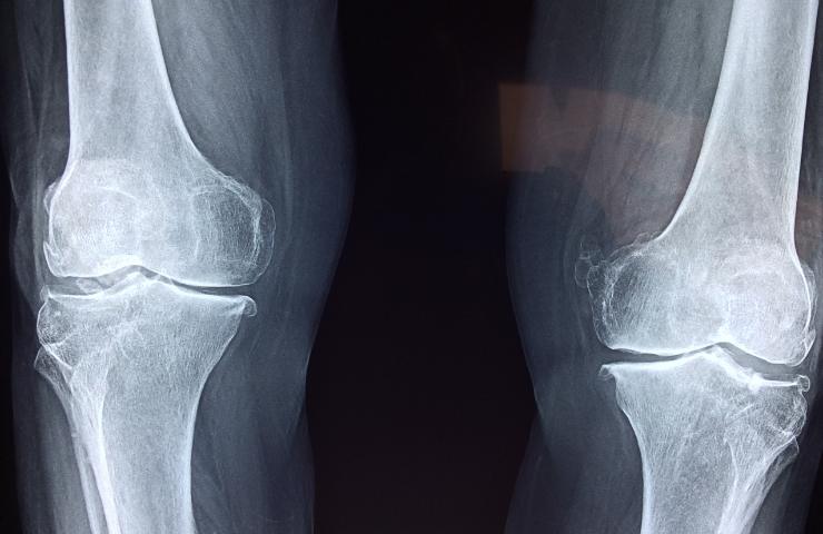 Qual è la malattia dalle ossa di cristallo e come si cura