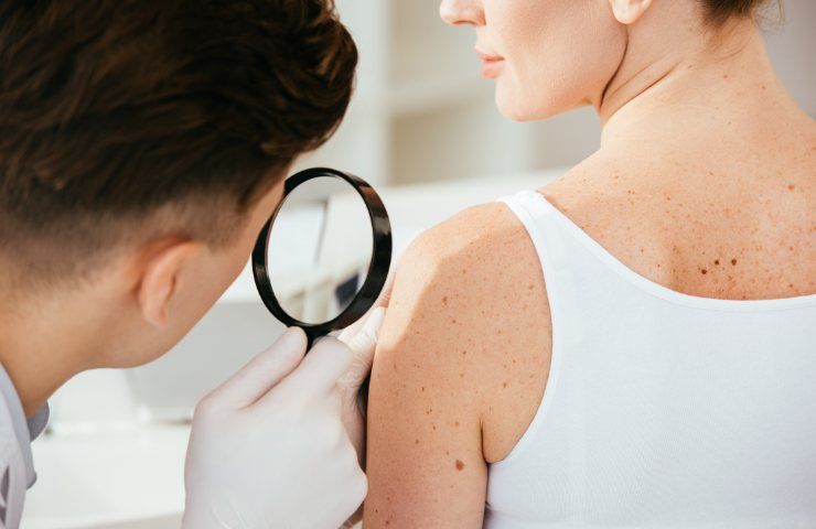 Come evitare un melanoma con l'abbronzatura