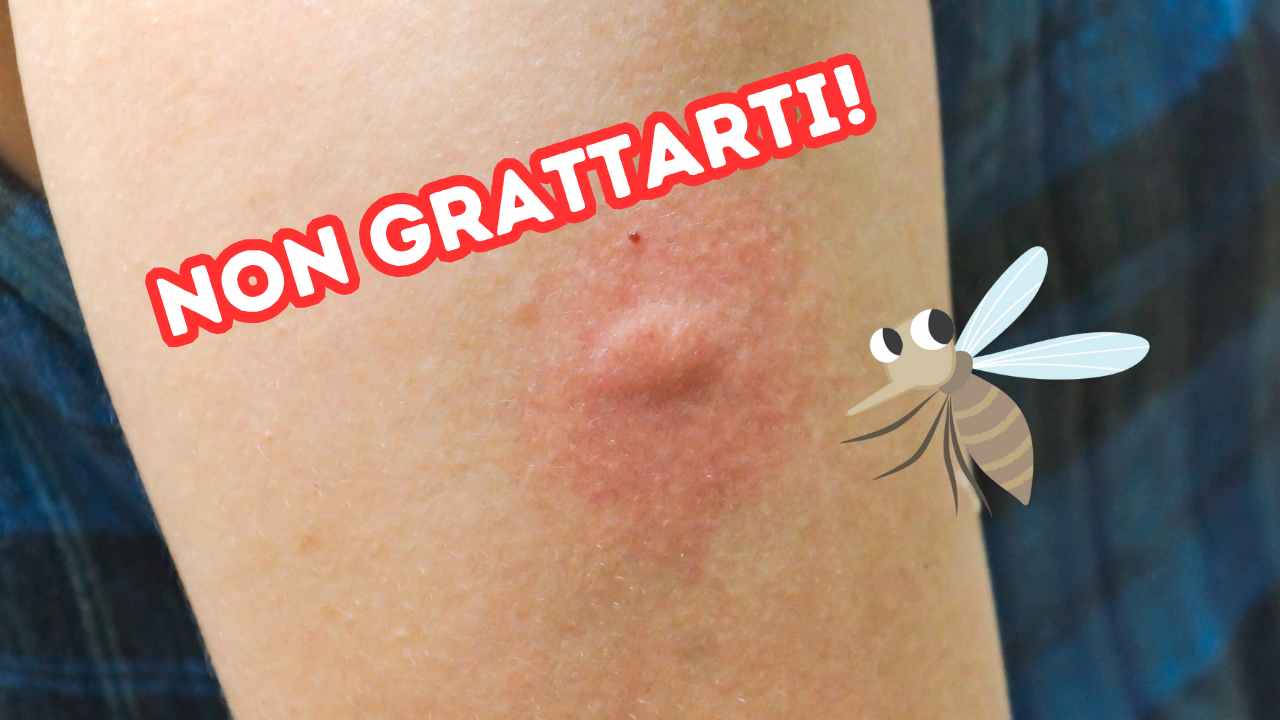 Come alleviare il prurito da puntura di zanzara