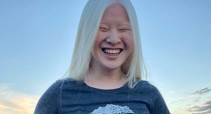 Genitori abbandonano figlia albina