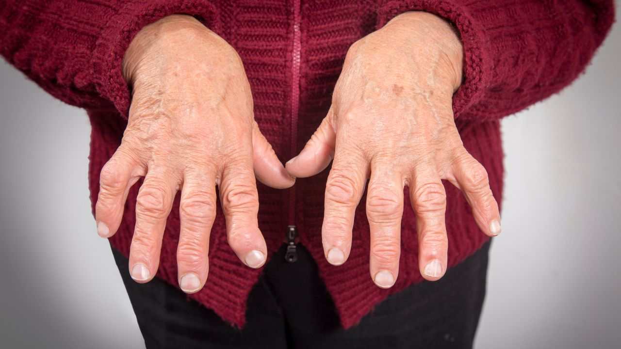 Artrite reumatoide sintomi