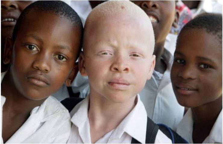 Bambino bello per il suo albinismo stupisce la Nigeria
