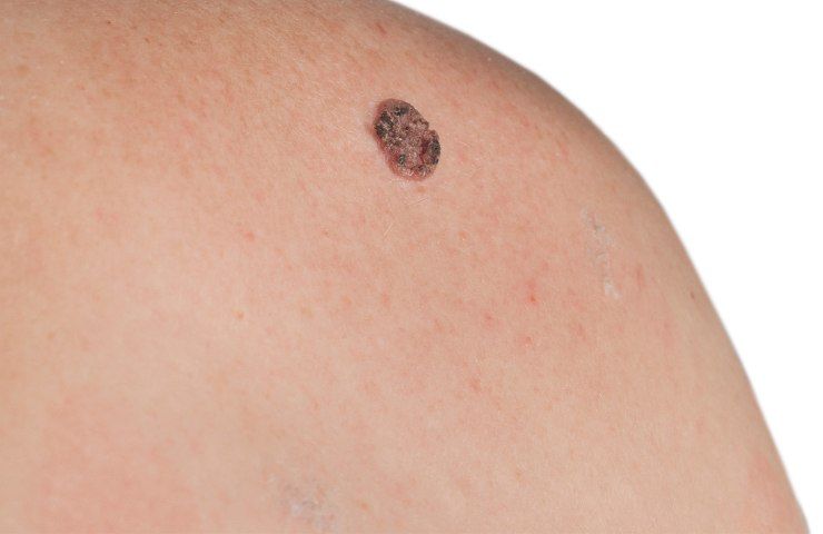tumore della pelle molto diffuso può essere evitato in un modo