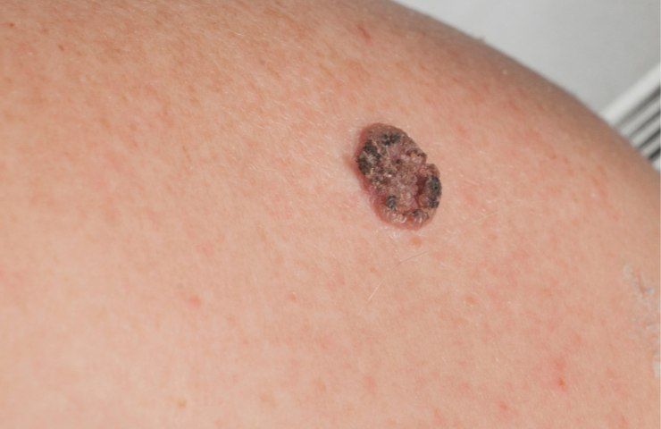 tumore della pelle molto diffuso può essere evitato in un modo