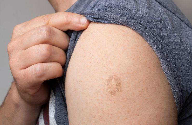 Cicatrice vaccino del vaiolo