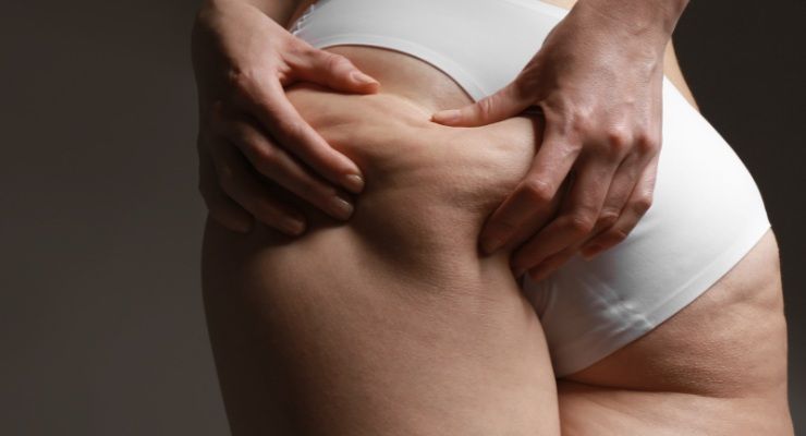 Cellulite alimenti miglioramenti