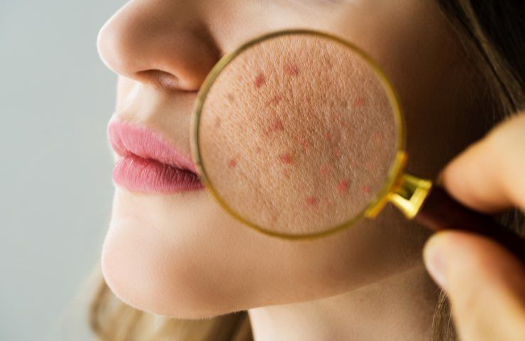 acne viso 