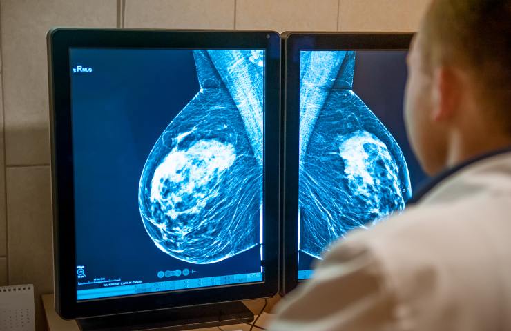 mammografia esame e screening