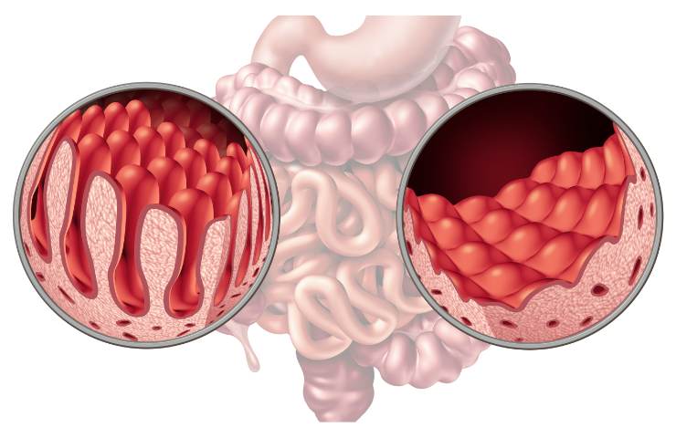 Sintomi della celiachia come riconoscerli e cosa fare