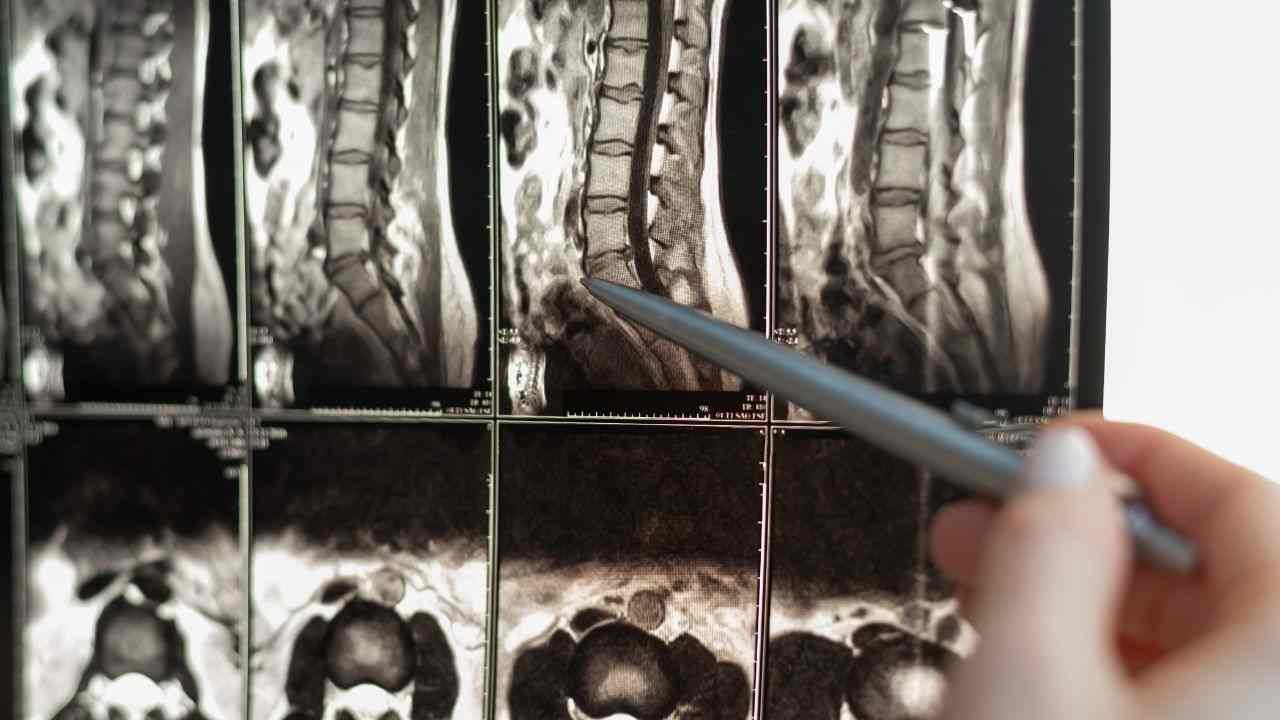 lesione midollo cura sperimentale