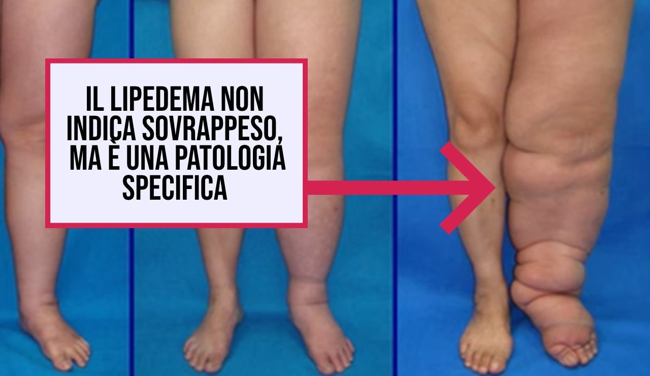 nuova tecnica lipoedema