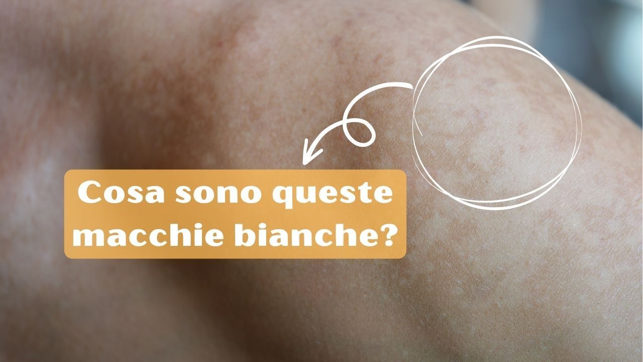 macchie bianche pelle