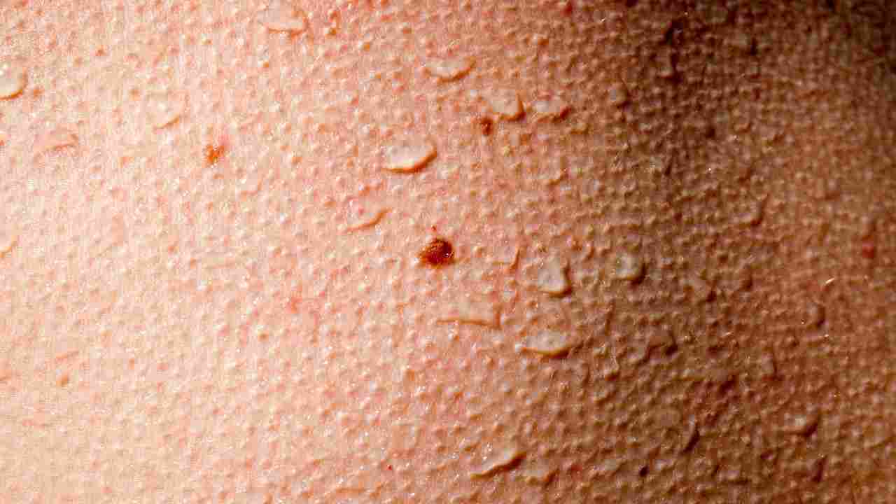pelle d'oca sintomo