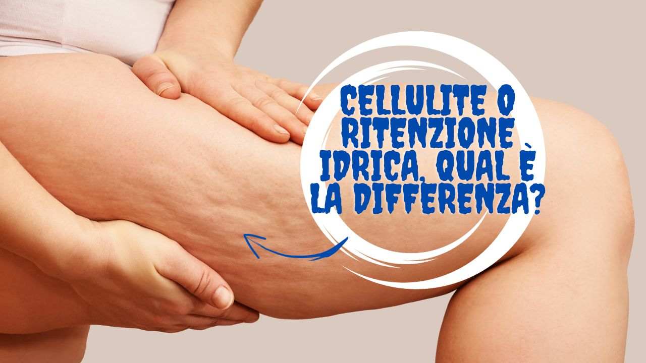 ritenzione idrica cellulite differenze