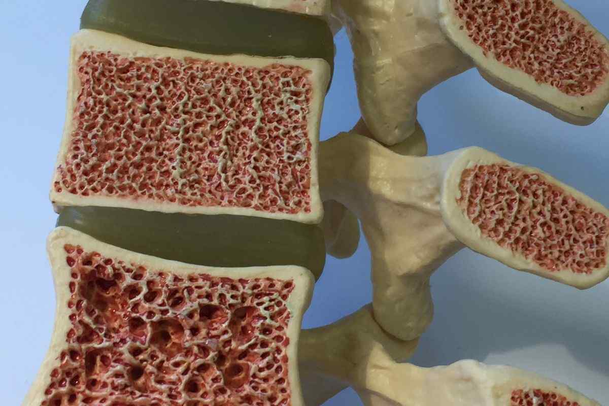 Osteoporosi divora le ossa