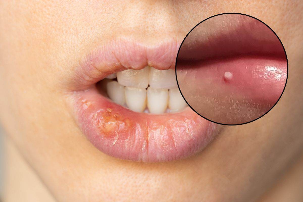 Labbra con herpes e con milia