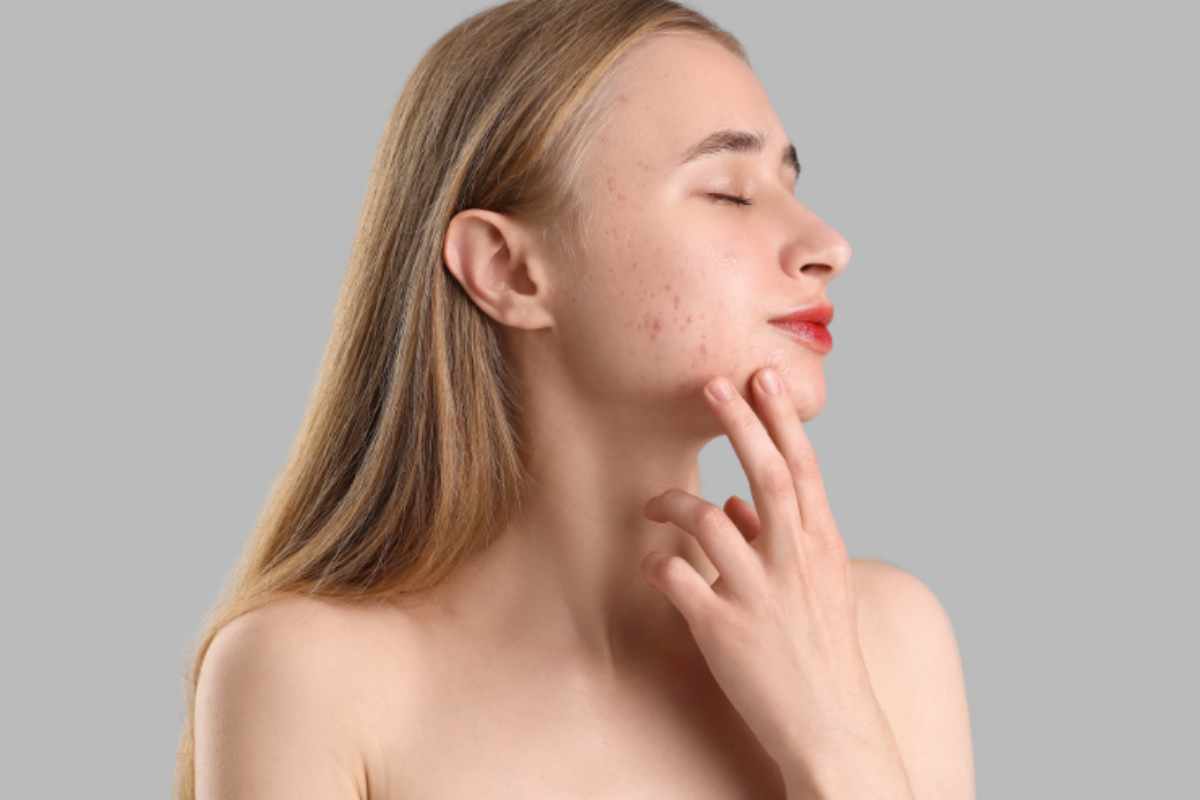 ragazza mostra la pelle con brufoli