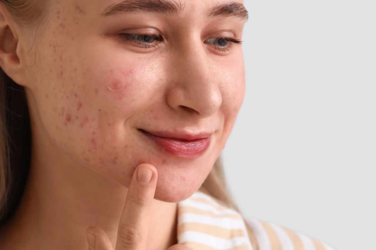 ragazza applica cerotti idrocolloidali 