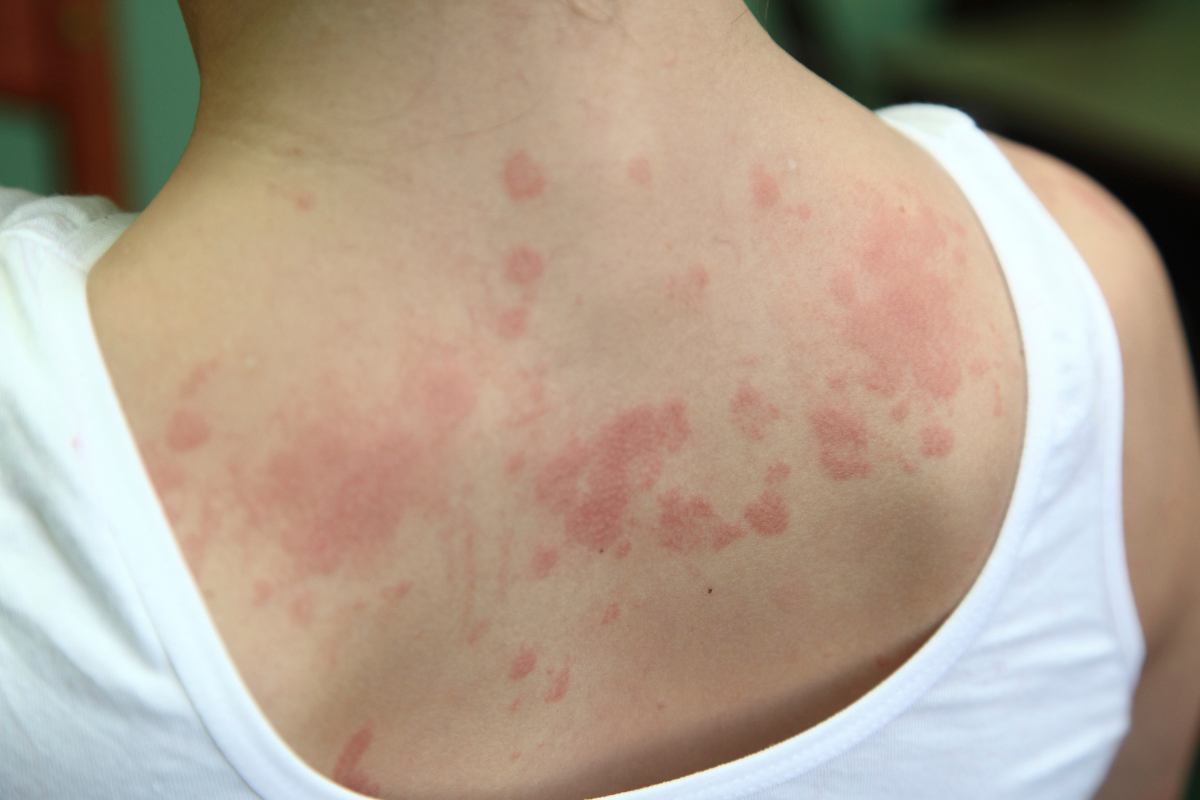 donna schiena dermatite